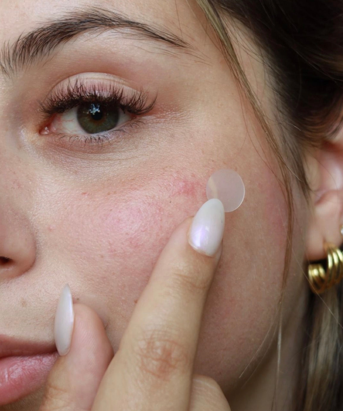 Acne Patch – 36 Patches Per Sheet | Overnight Pimple Healing Stickers